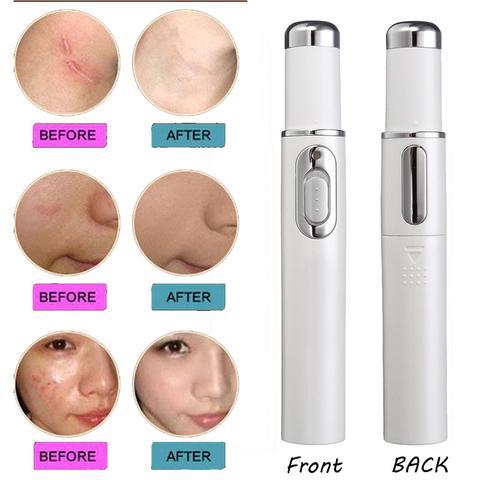 Blue Light Laser Therapy Pen For Acne & Wrinkle Removal - Image 3