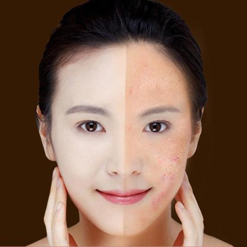 Blue Light Laser Therapy Pen For Acne & Wrinkle Removal - Image 8